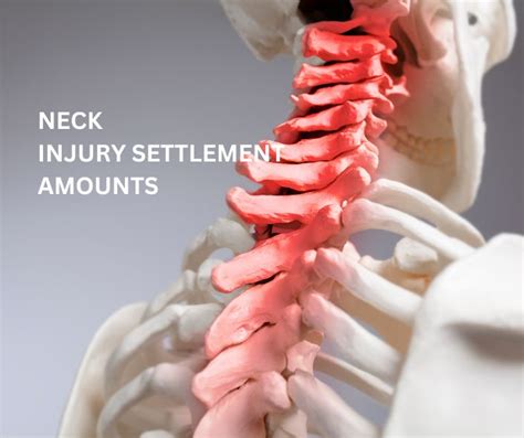 In your time of need, let us help you get your life back on track. . Neck injury settlement calculator